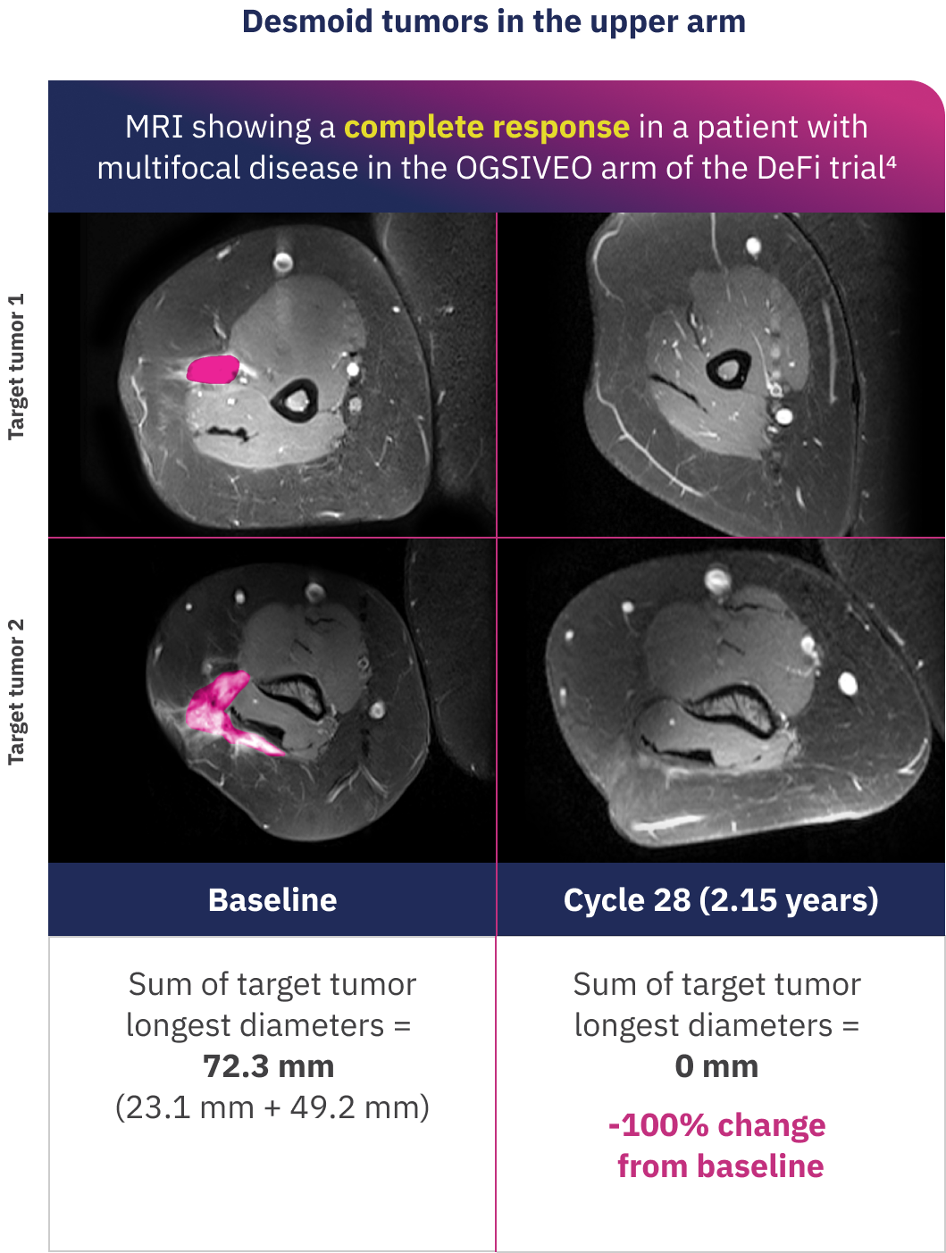 MRI showing a complete response in a patient with multifocal disease in the OGSIVEO arm of the DeFi trial